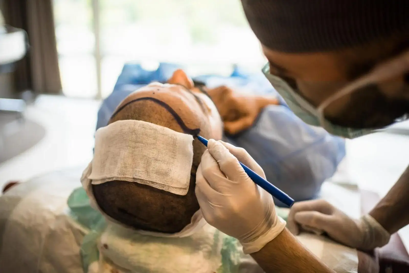 Costo del trapianto di capelli con 5000 innesti in Turchia - Estemoon