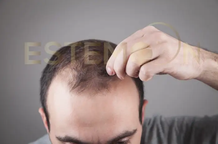 Diagnosing Thyroid Hair Loss and Ruling Out Other Causes
