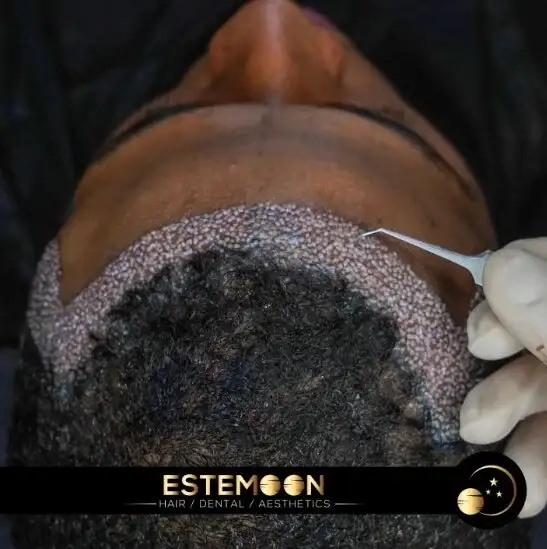 Hair Transplant Recovery Time: What to Know Before Going to Albania