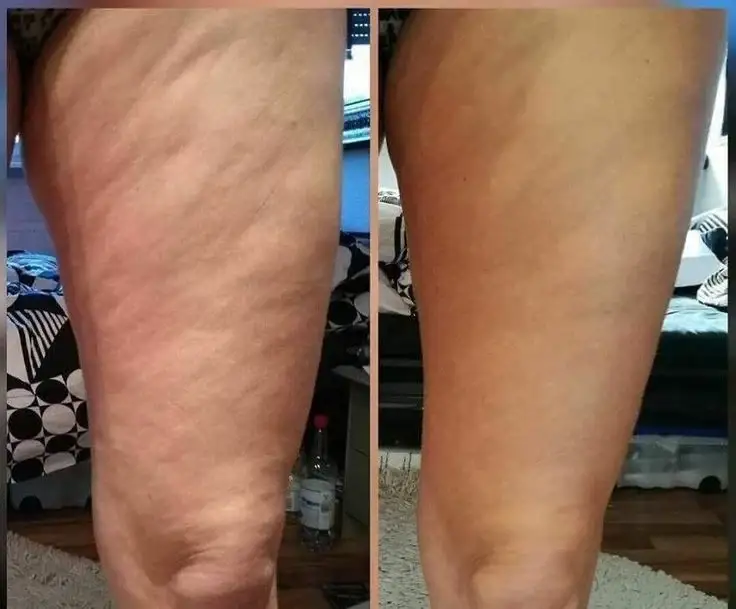 Thigh Lift in Turkey - Get Your Dream Thighs