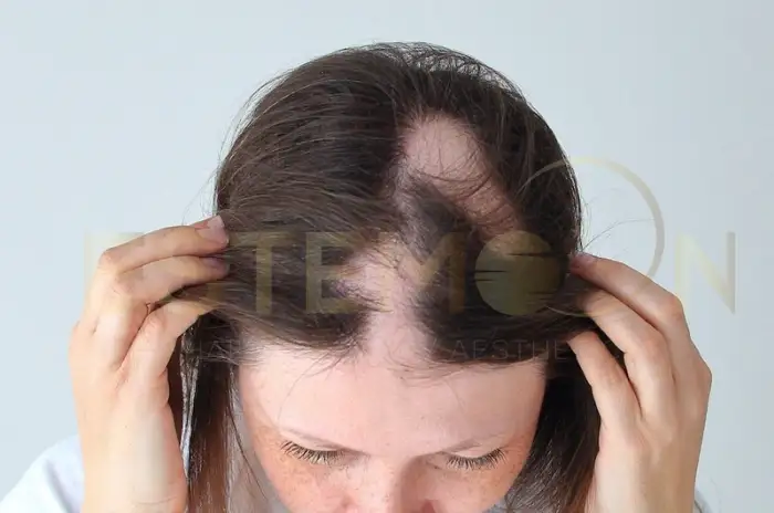 Autoimmune Hair Loss Causes Symptoms and Treatments