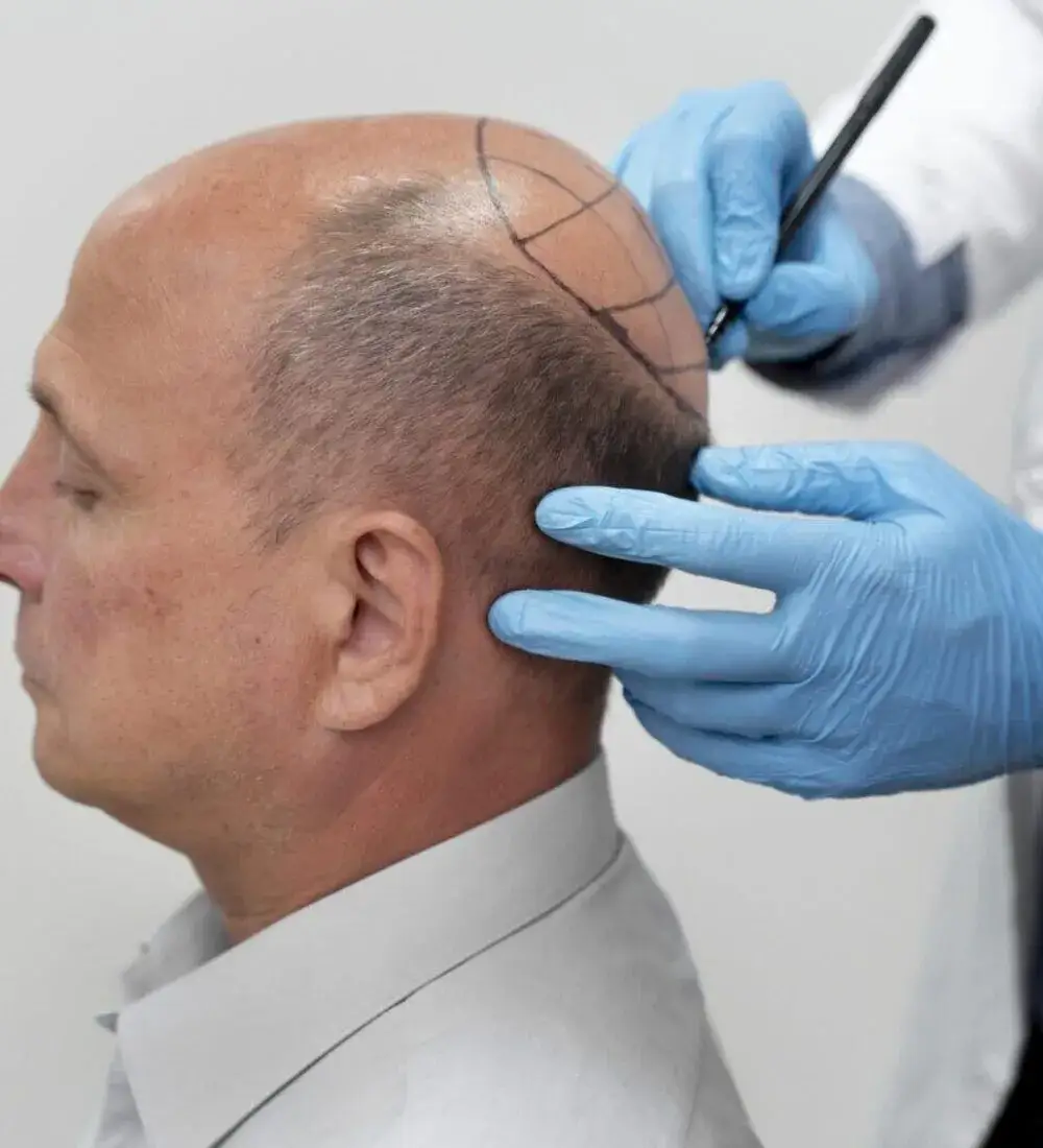 fue-transplant-de-par-inainte-si-dupa