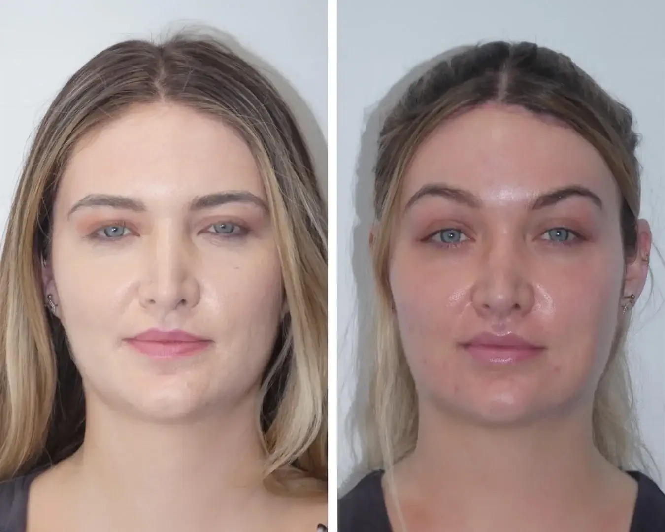 eyebrow-lift