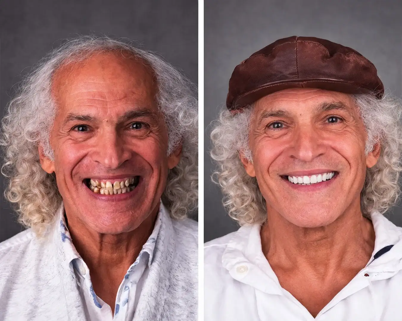 hollywood-smile-before-and-after