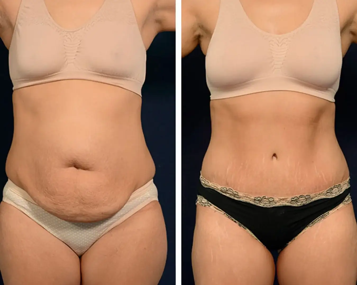 tummy-tuck-before-after