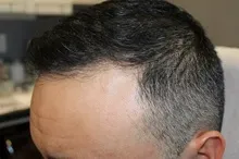 after-hair-transplant