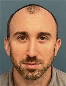hair-transplant-before