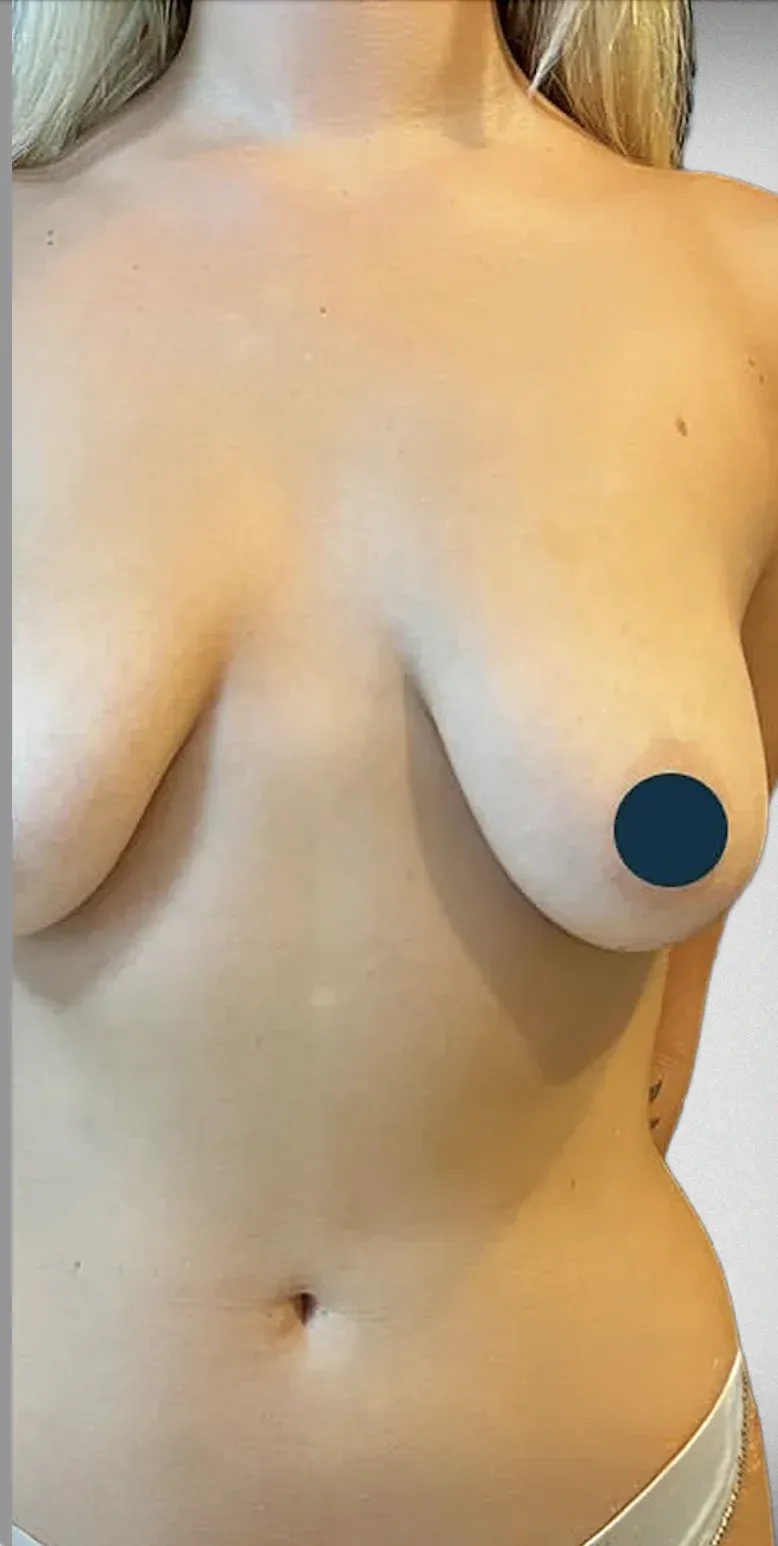 Breast Lift