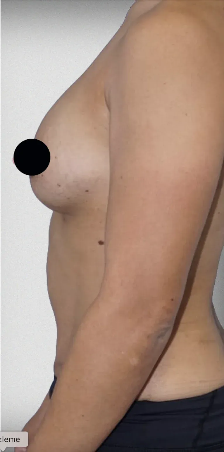 Breast Lift10