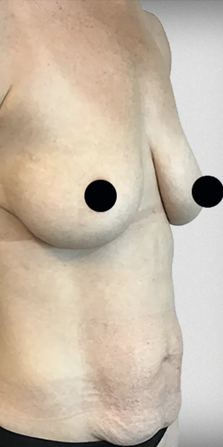 Breast Lift11