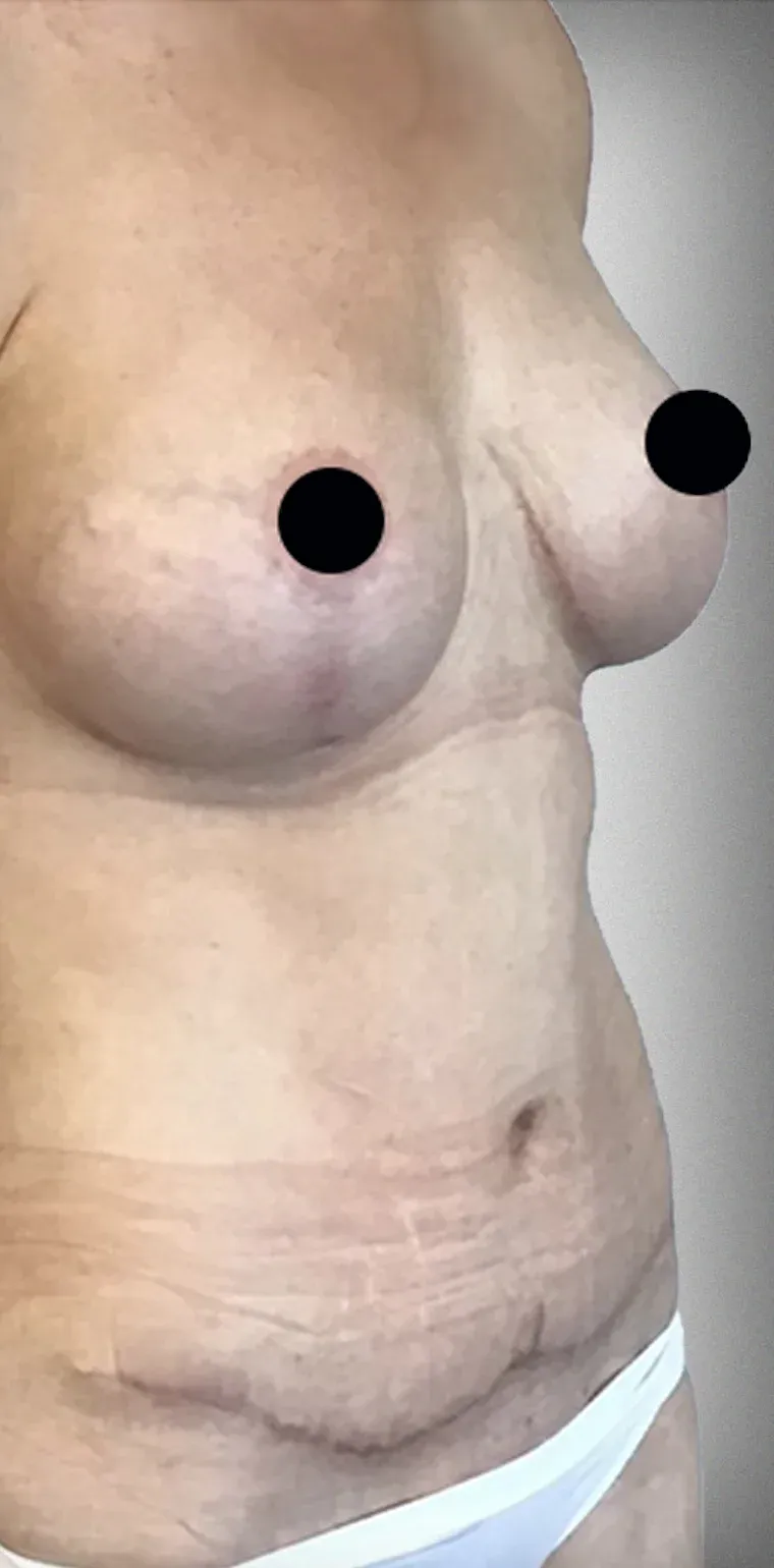 Breast Lift12