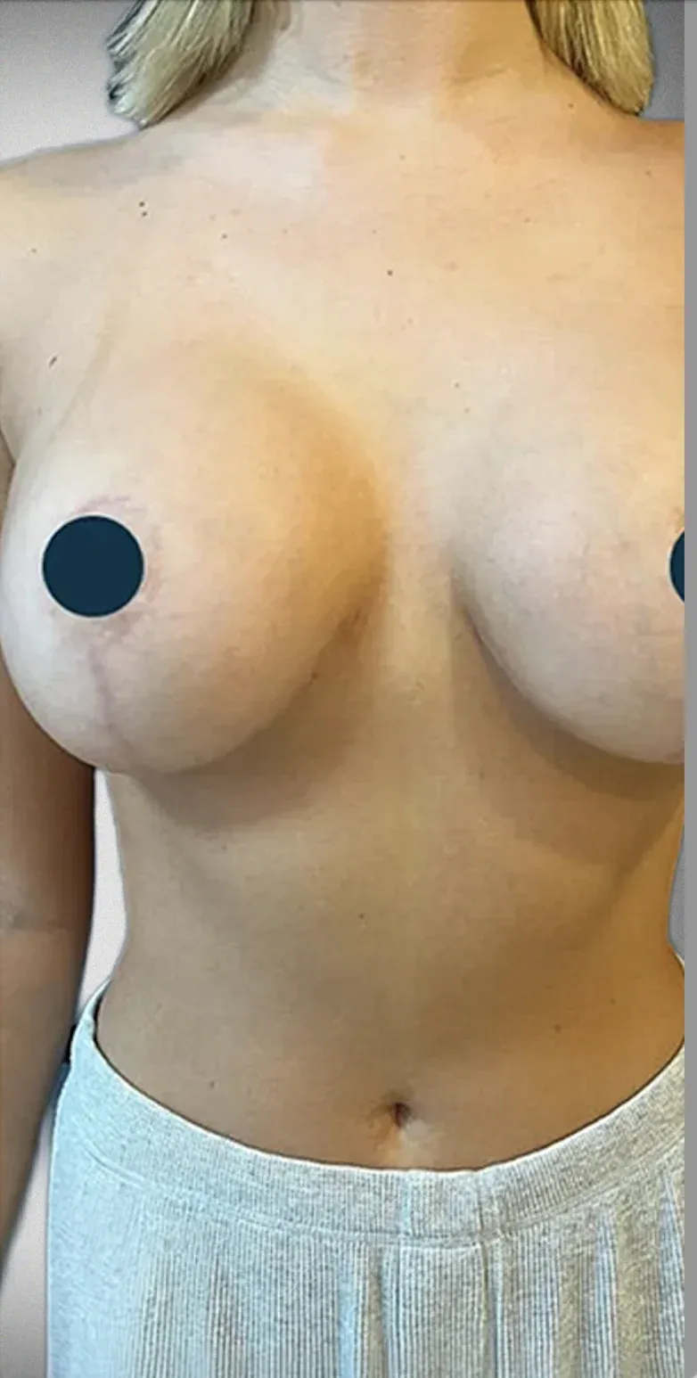 Breast Lift2