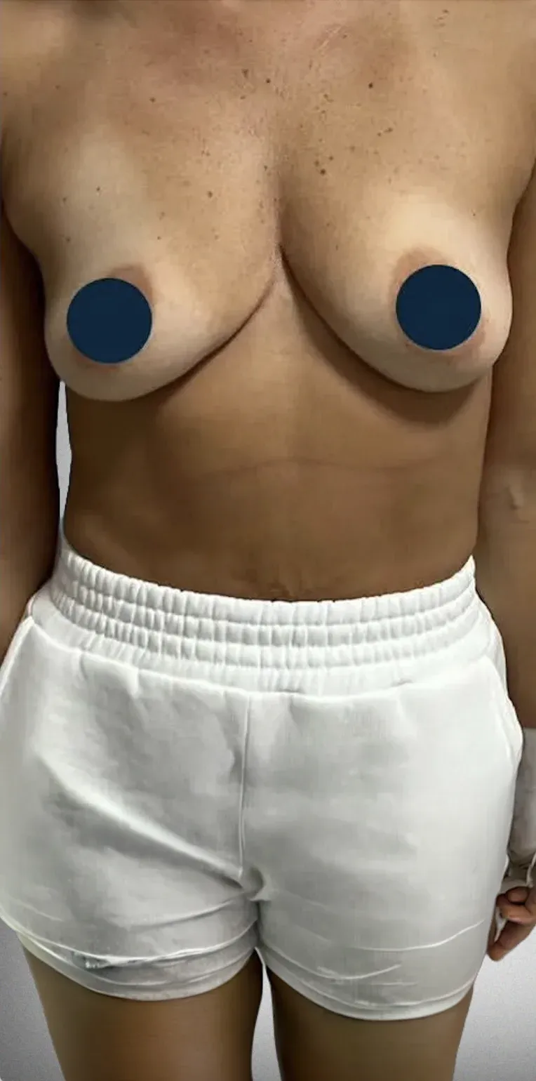 Breast Lift3