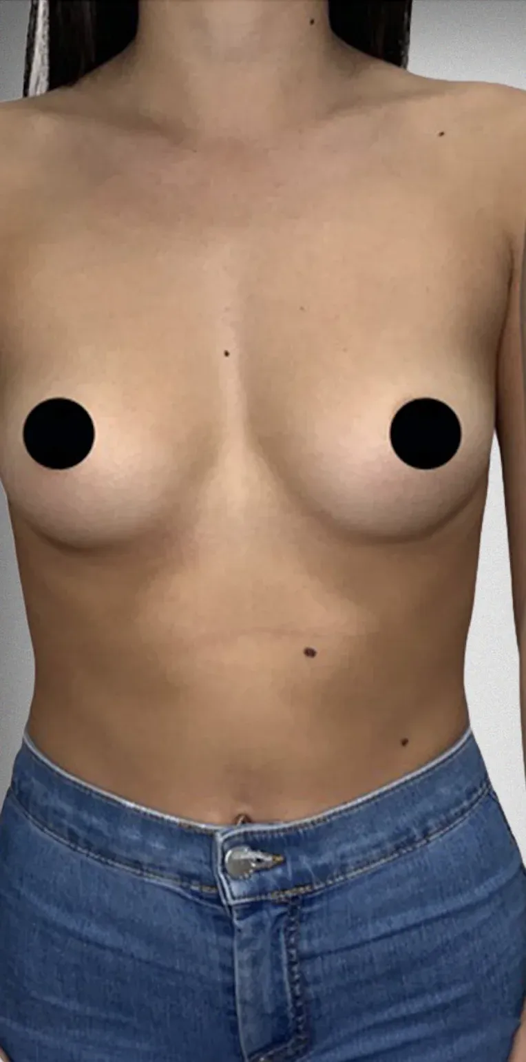 Breast Lift5