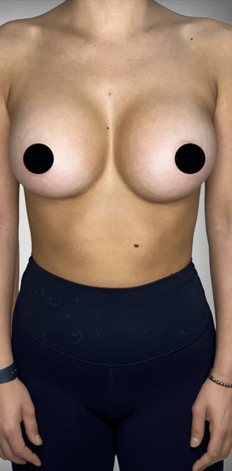 Breast Lift6