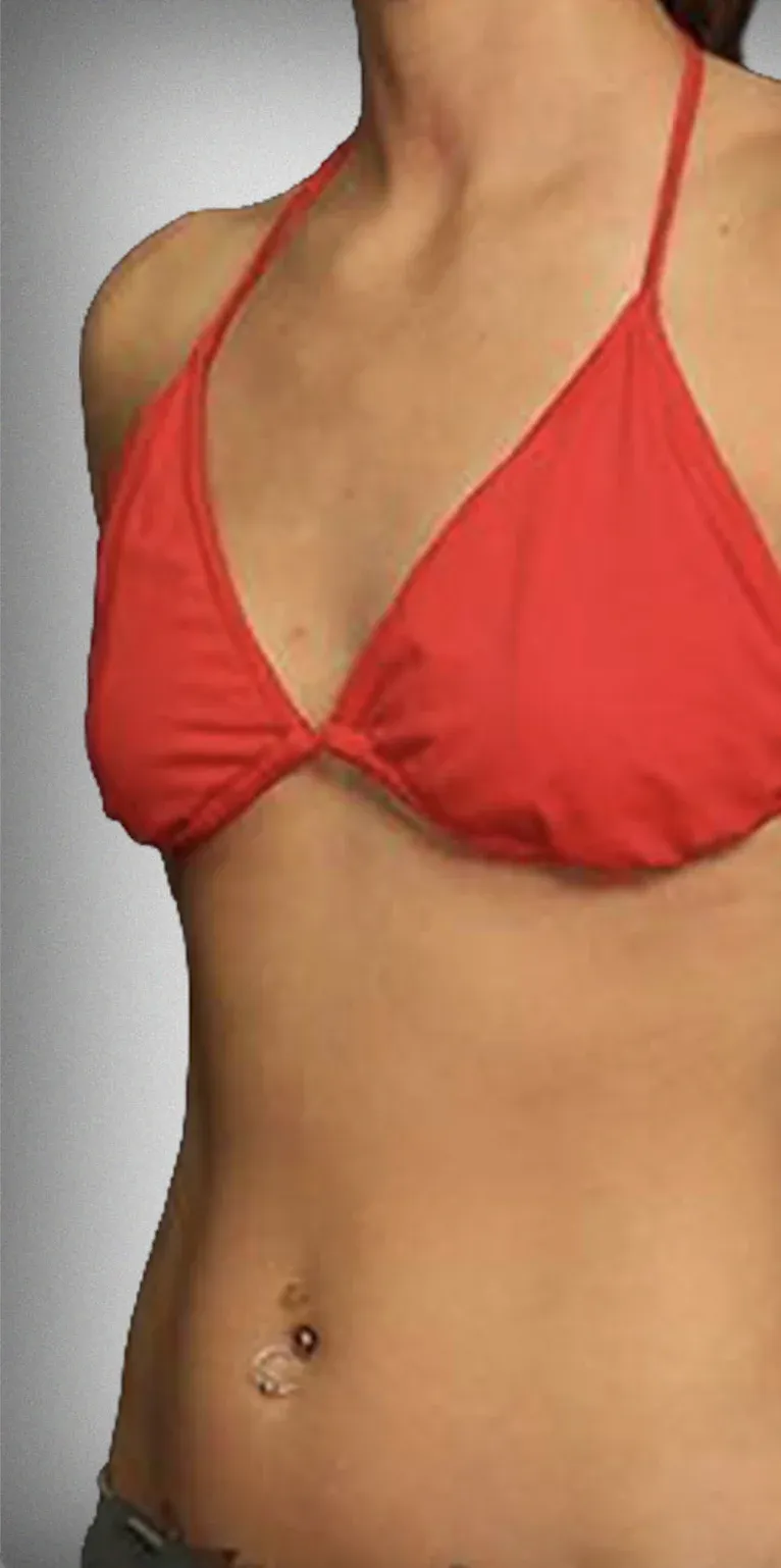 Breast Lift7