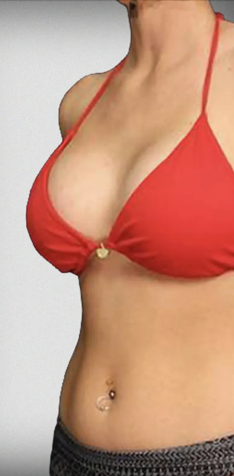Breast Lift8
