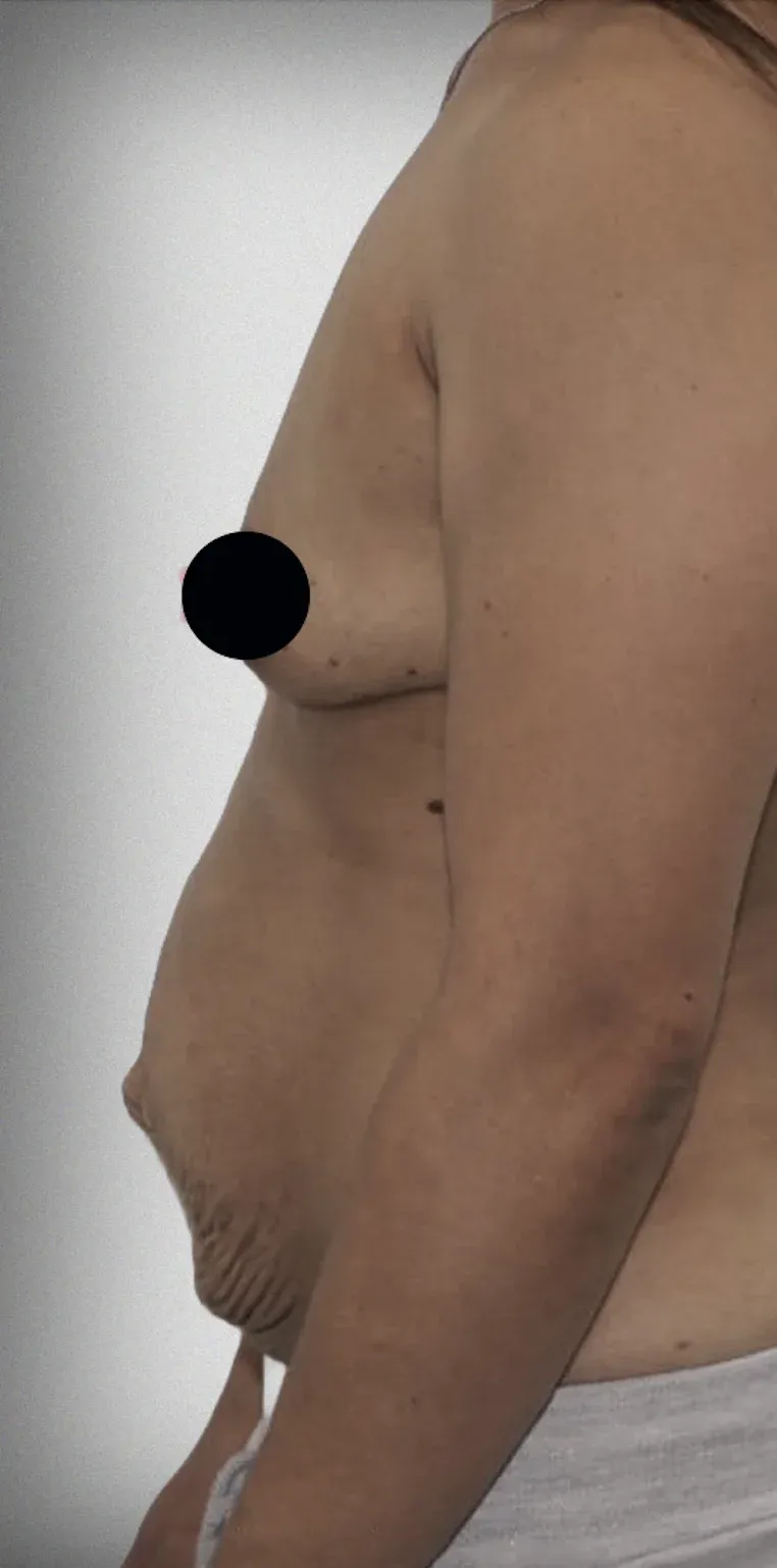 Breast Lift9