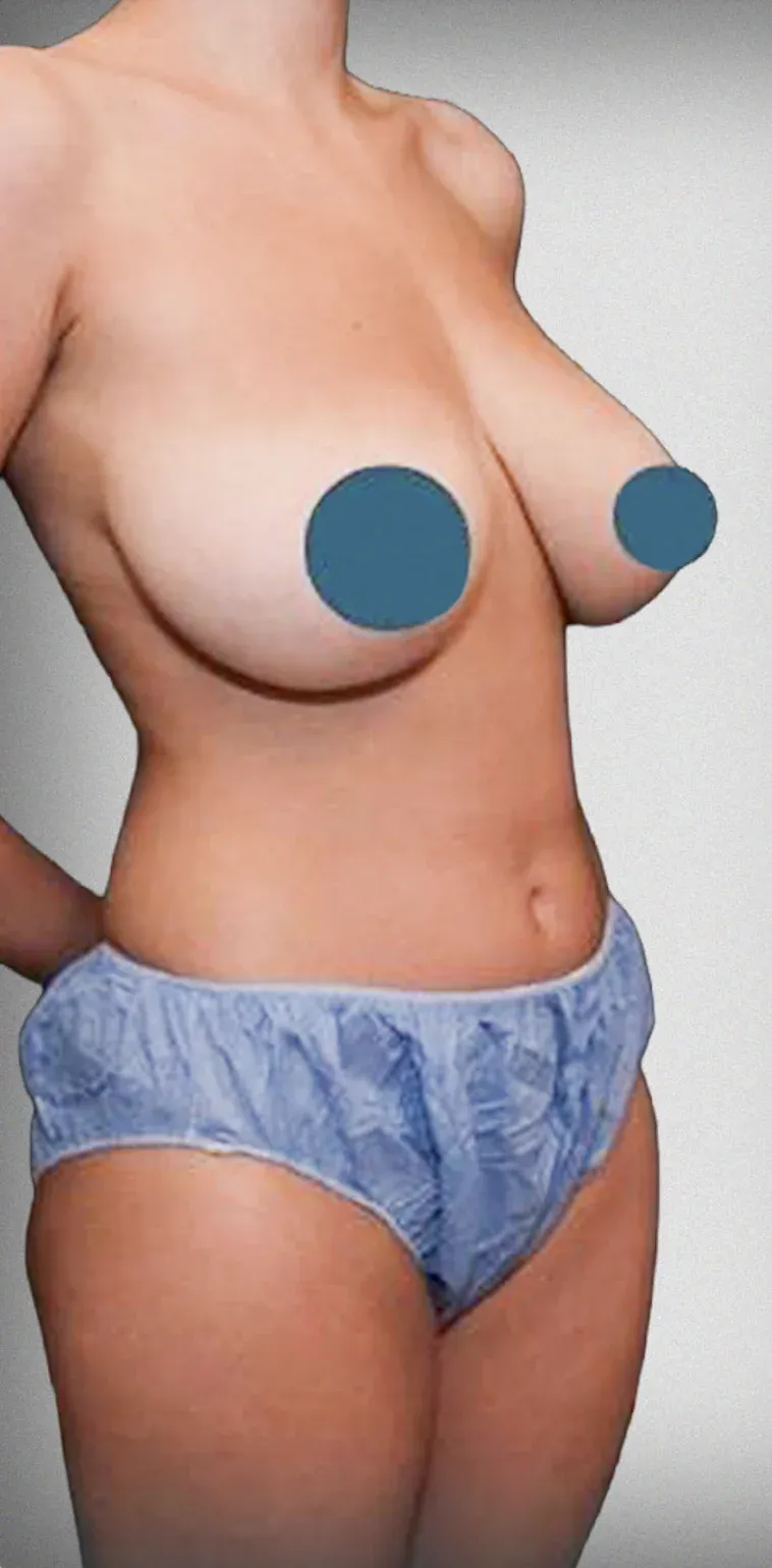 Breast Reduction