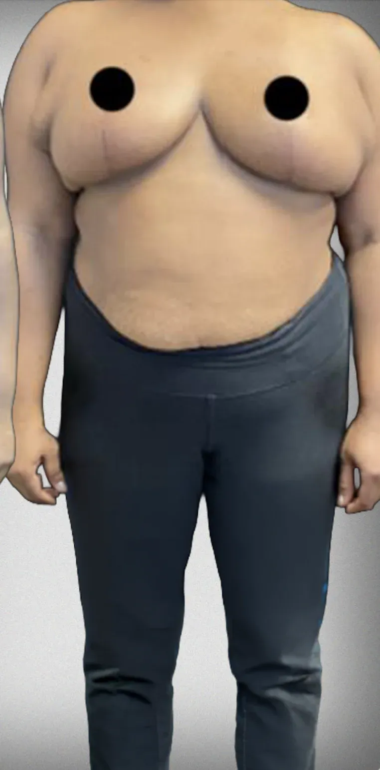 Breast Reduction10