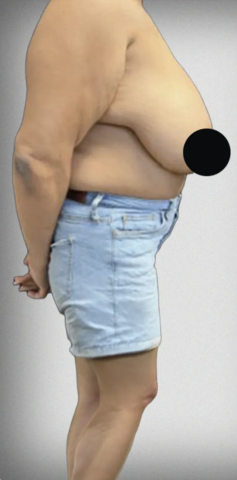 Breast Reduction11
