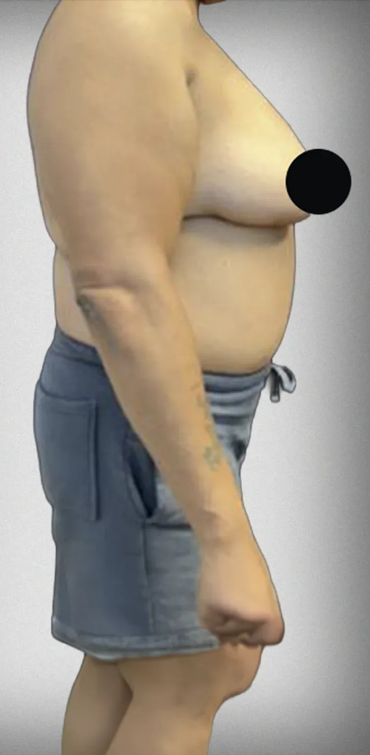Breast Reduction12