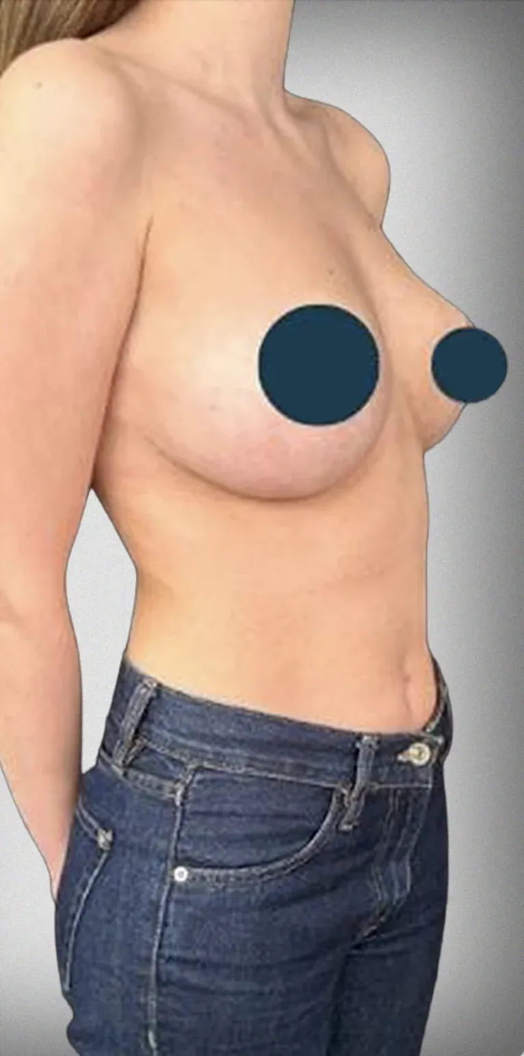 Breast Reduction2