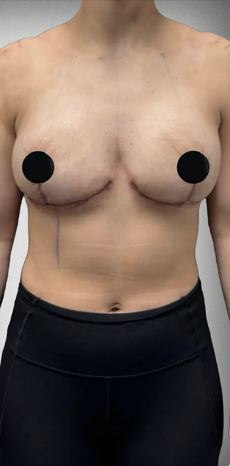 Breast Reduction4