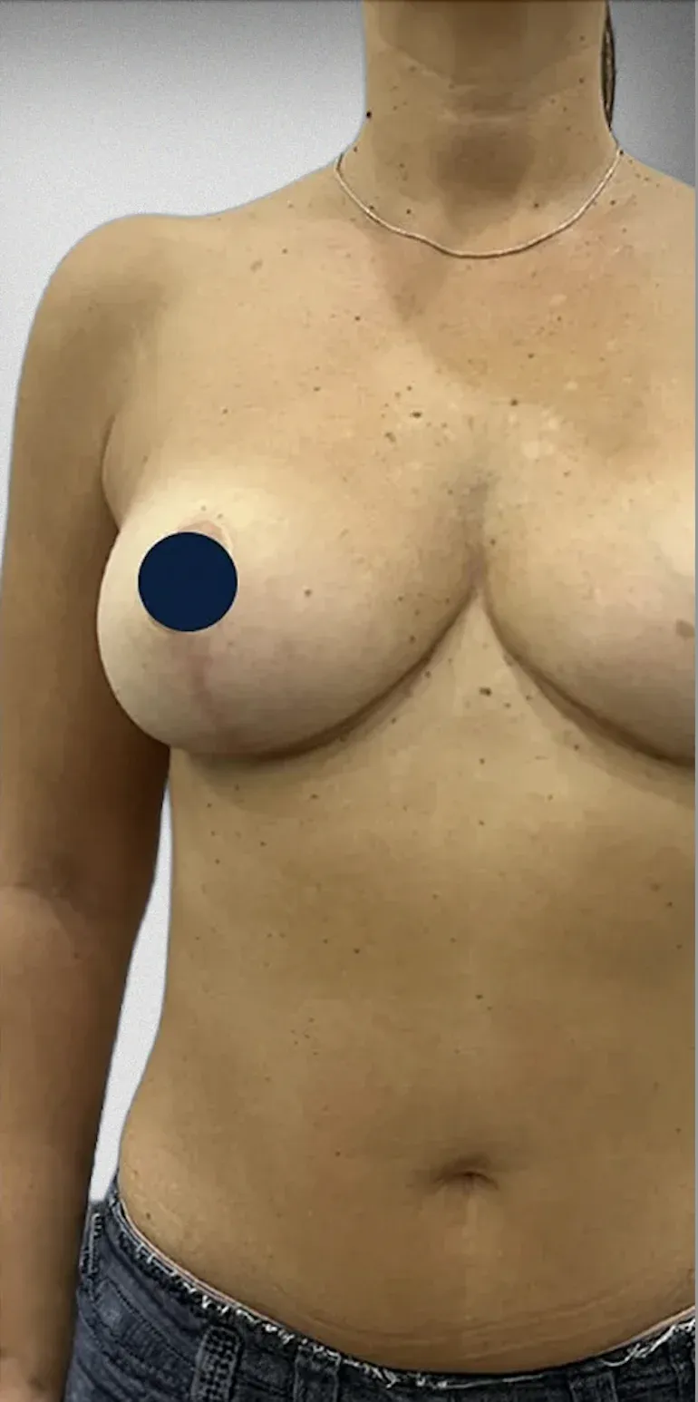 Breast Reduction6