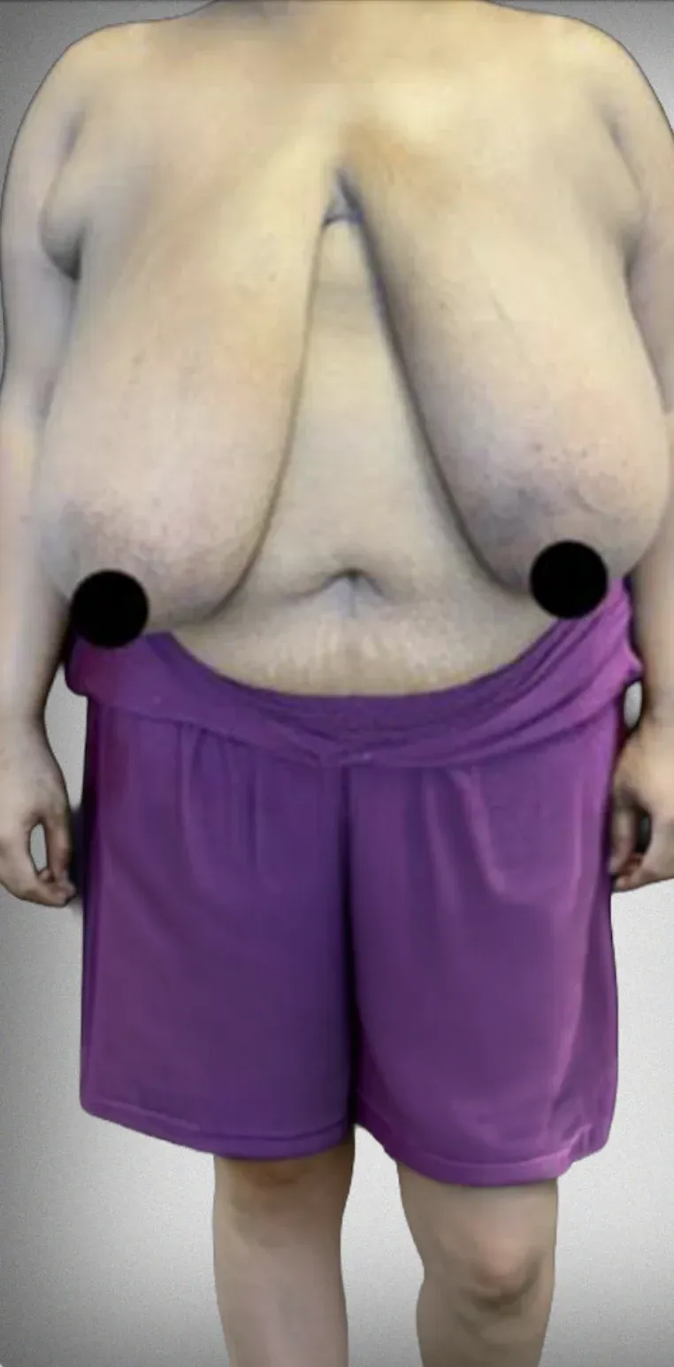 Breast Reduction9