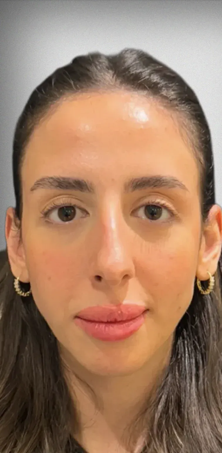 Brow Lift