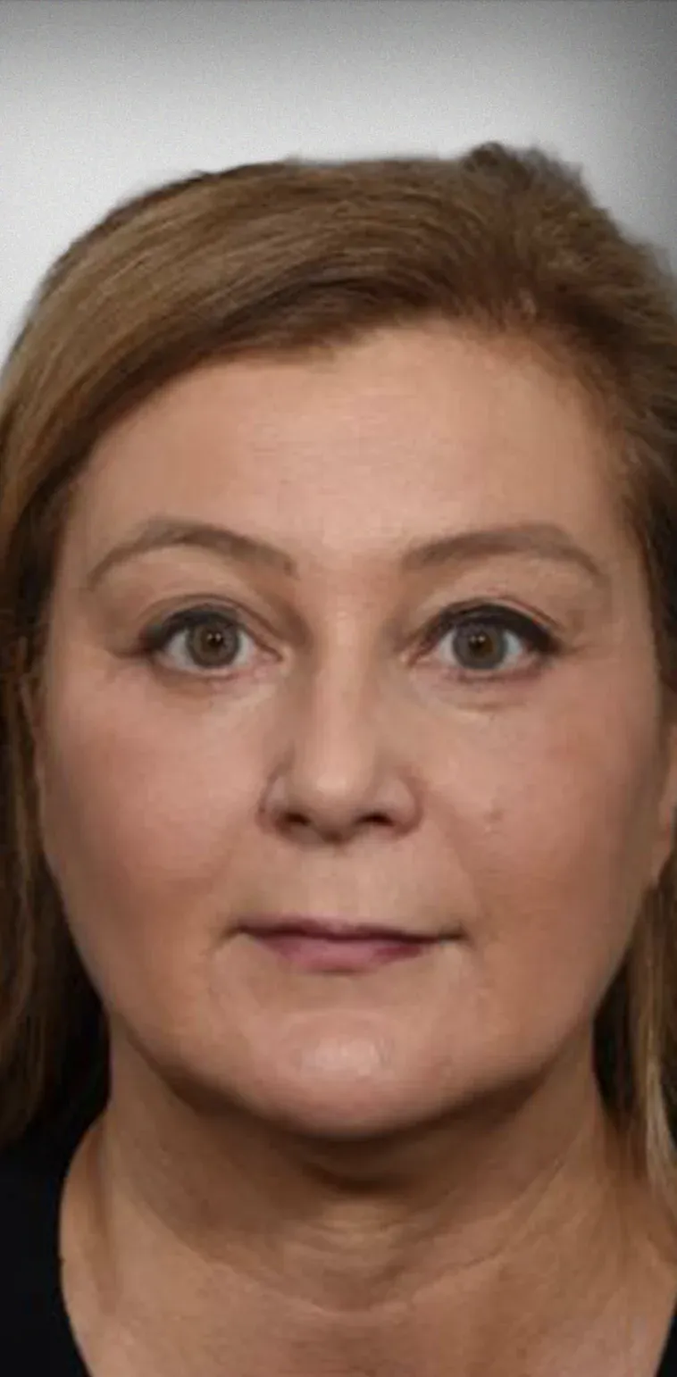 Brow Lift10