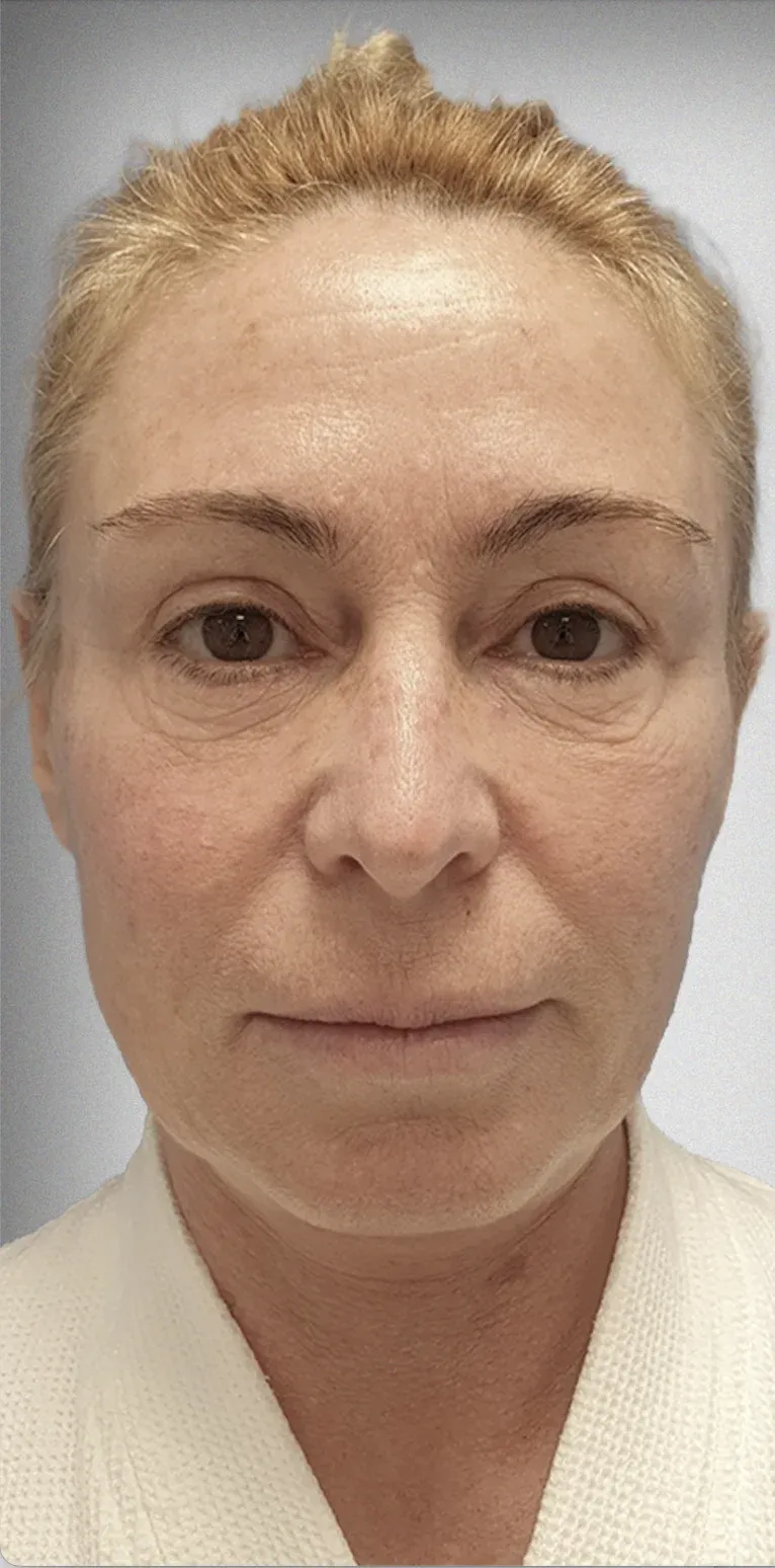 Brow Lift11