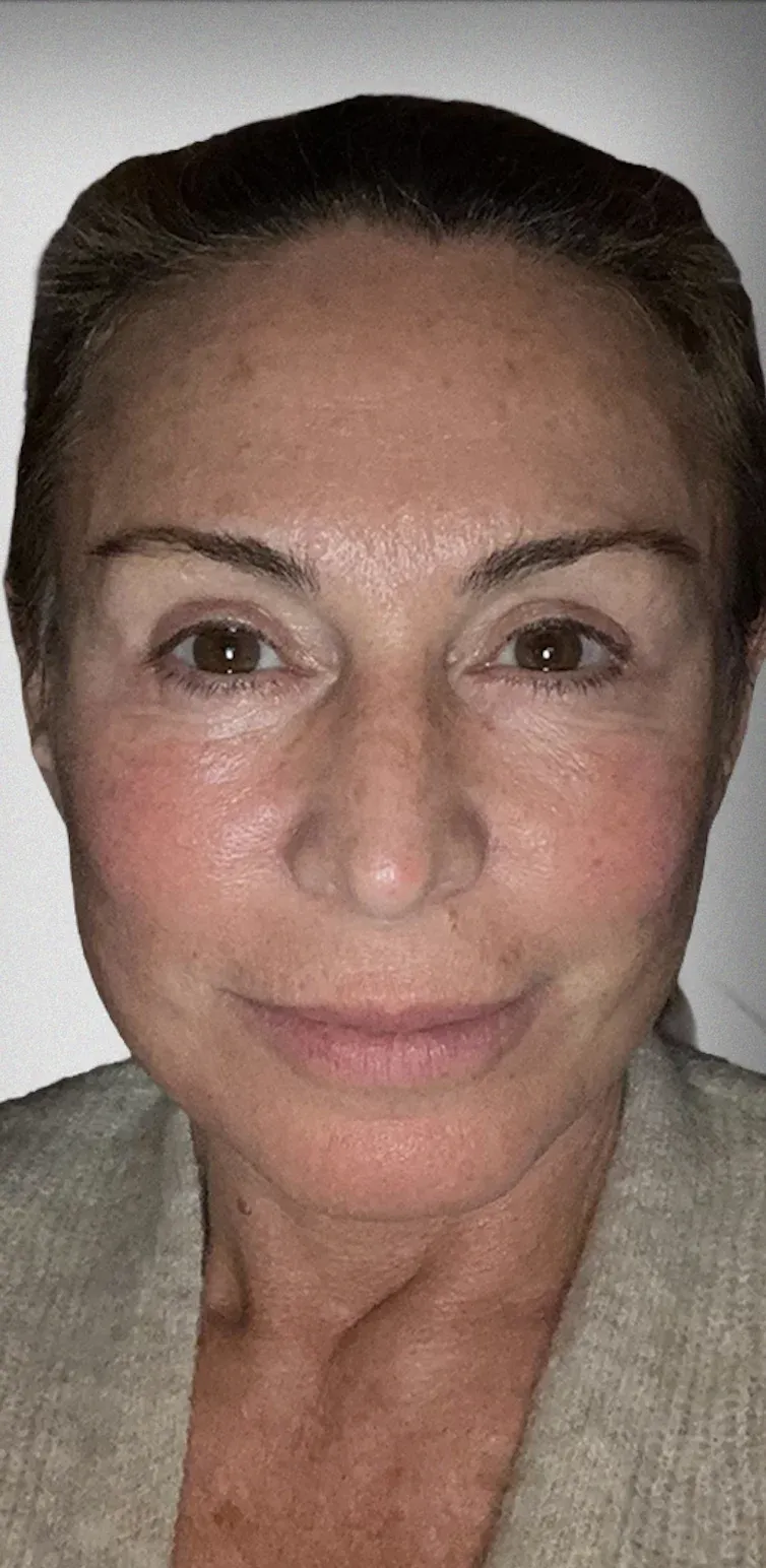 Brow Lift12