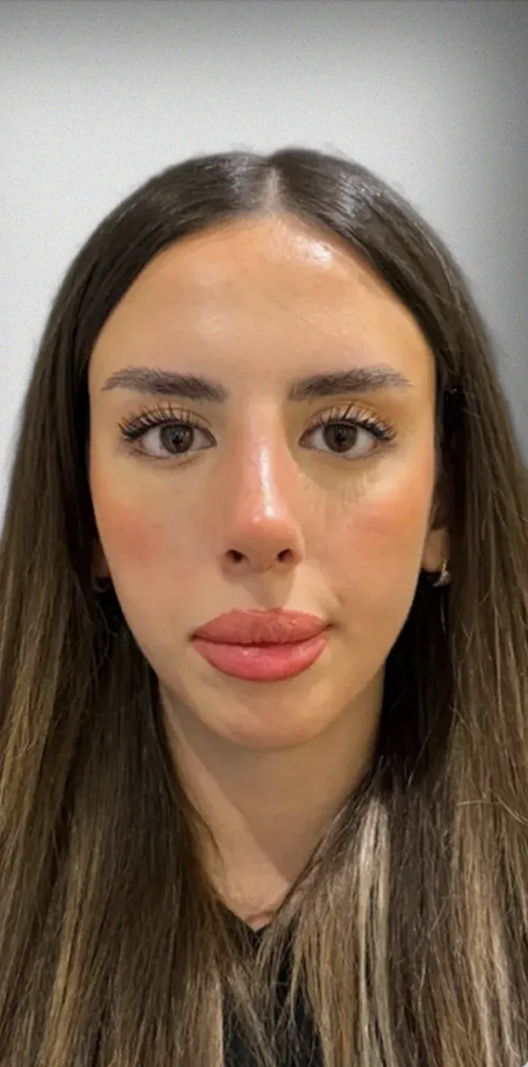 Brow Lift2