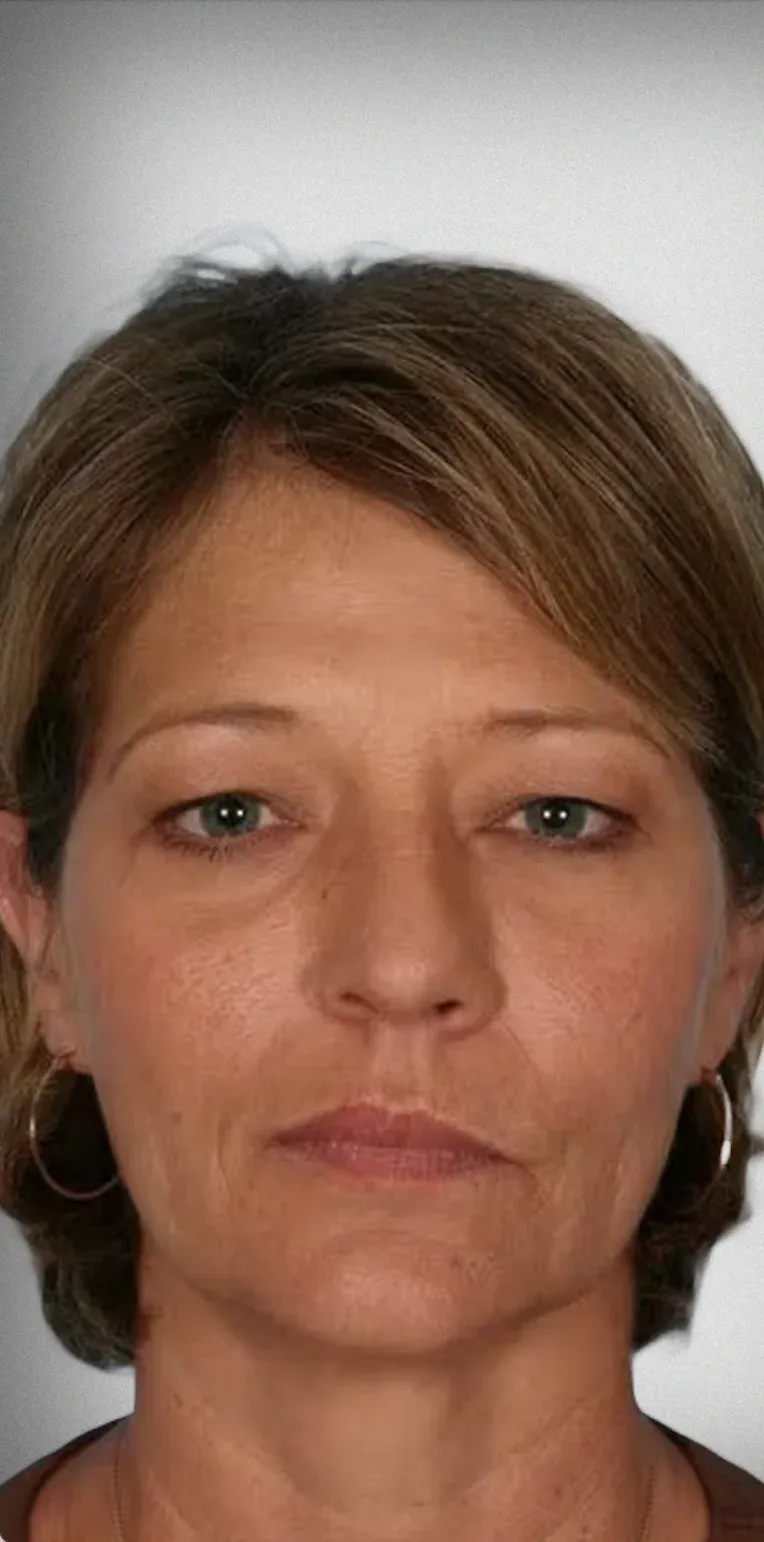 Brow Lift3