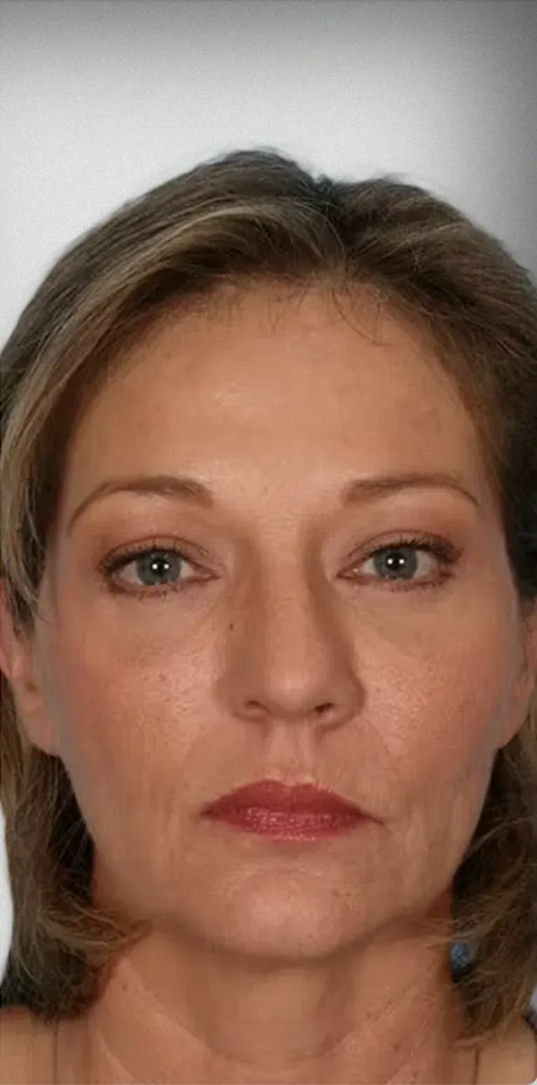 Brow Lift4