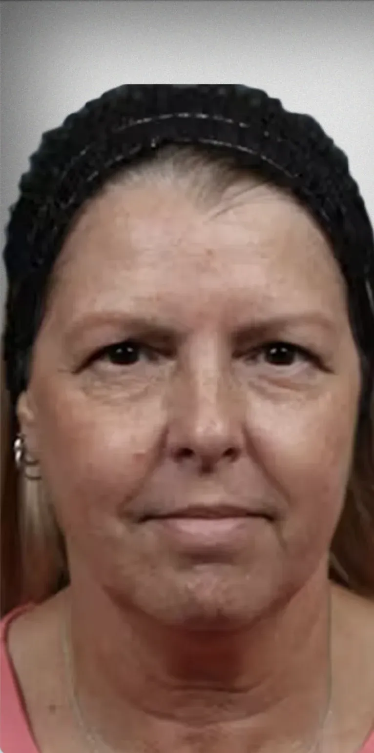 Brow Lift5