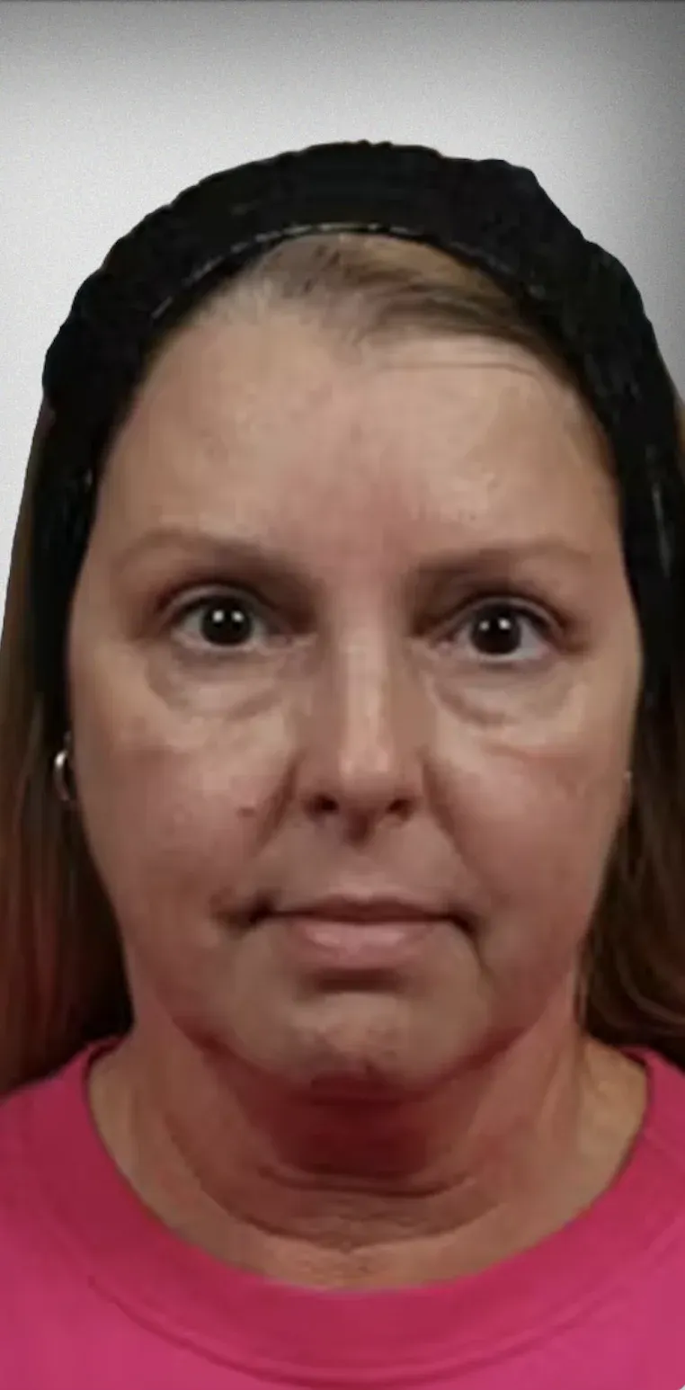 Brow Lift6