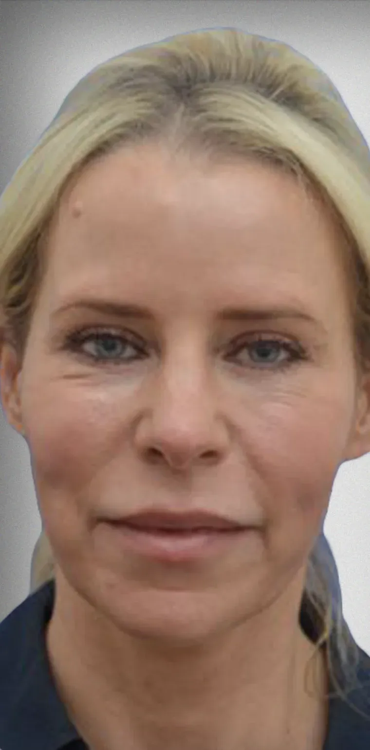 Brow Lift7