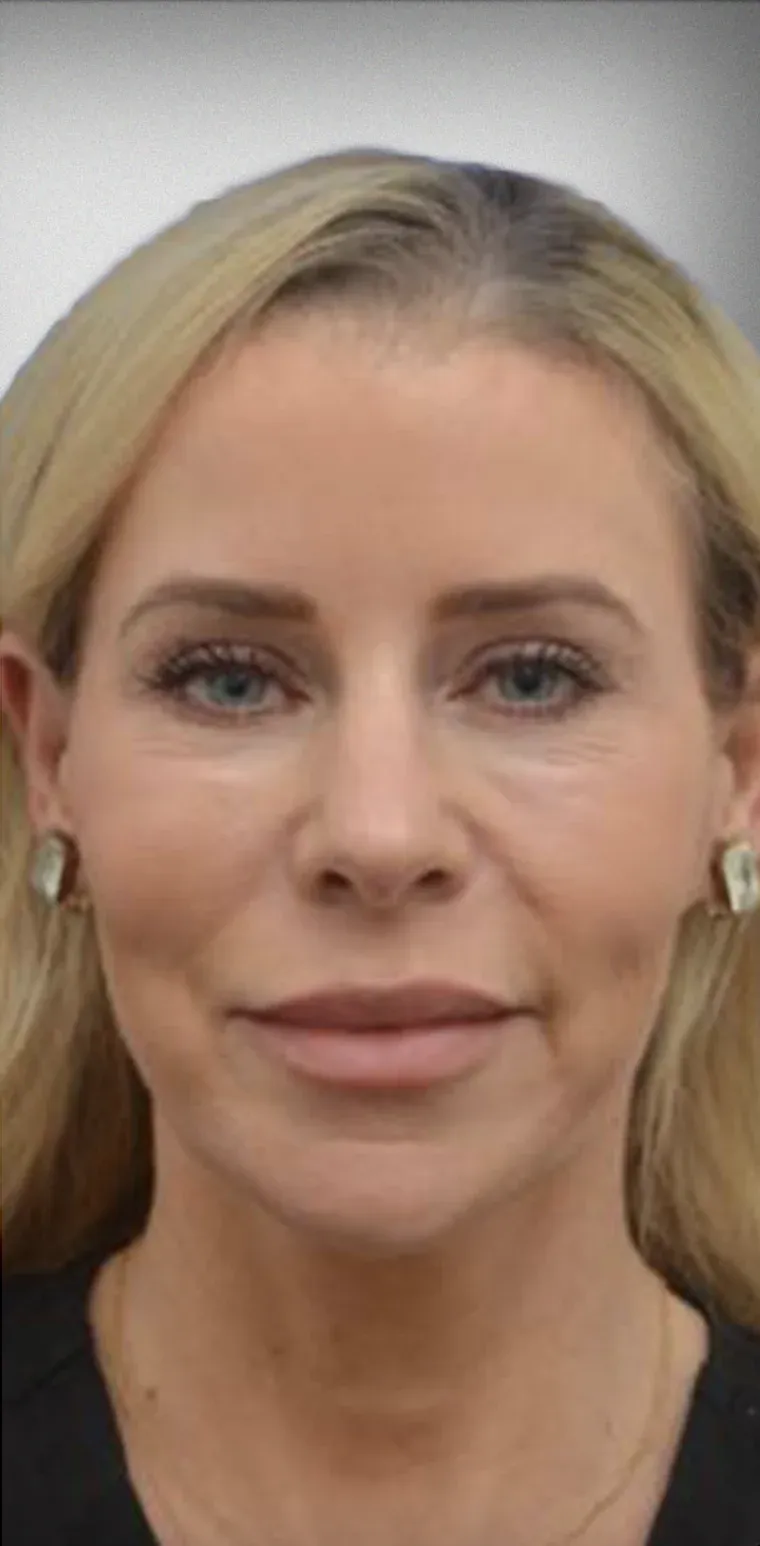 Brow Lift8