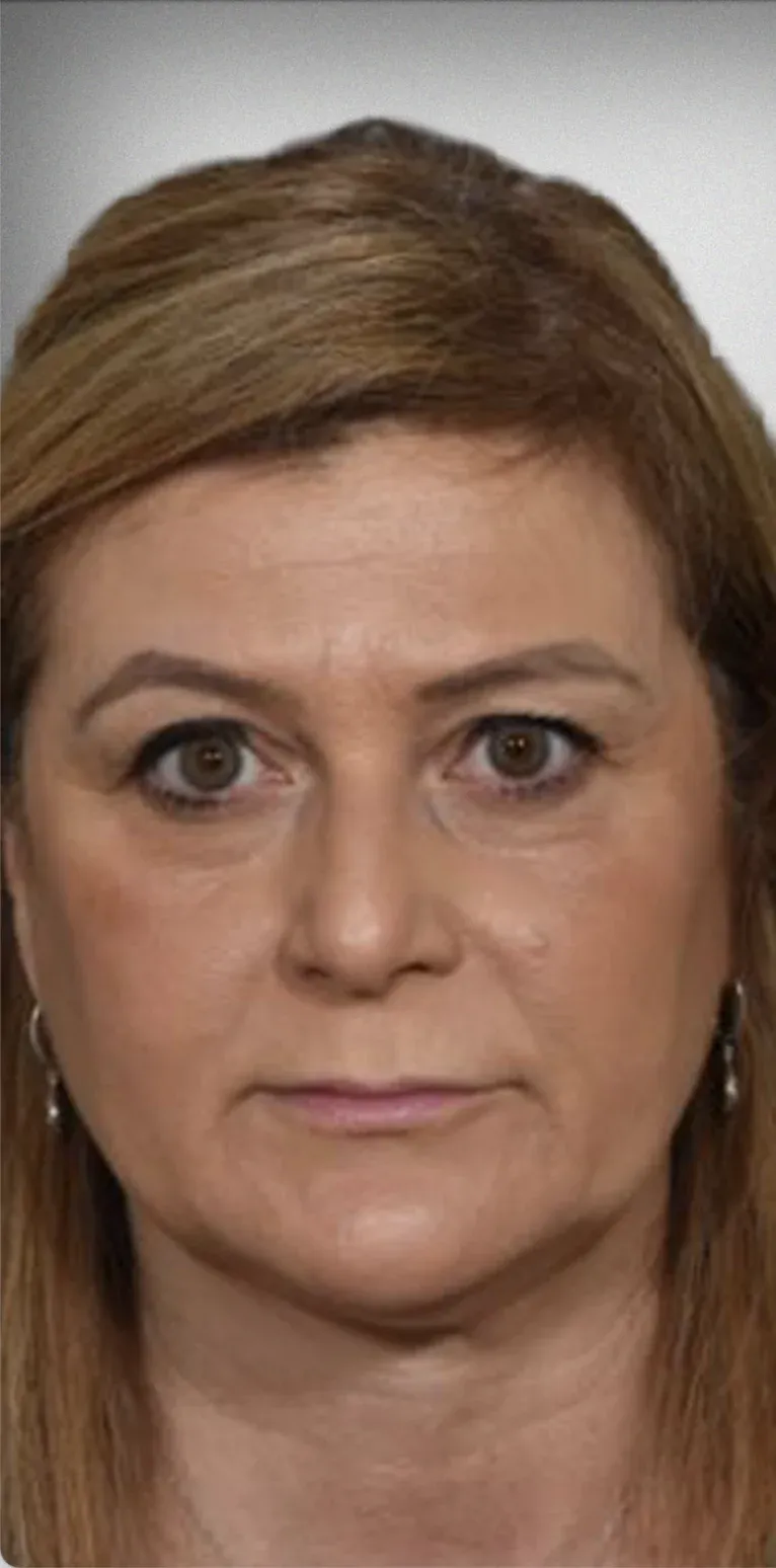Brow Lift9