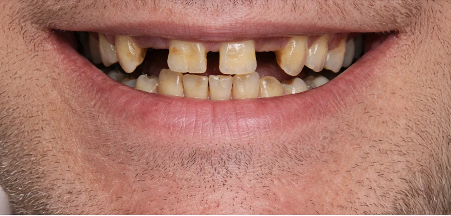 Dental Implant before-after11