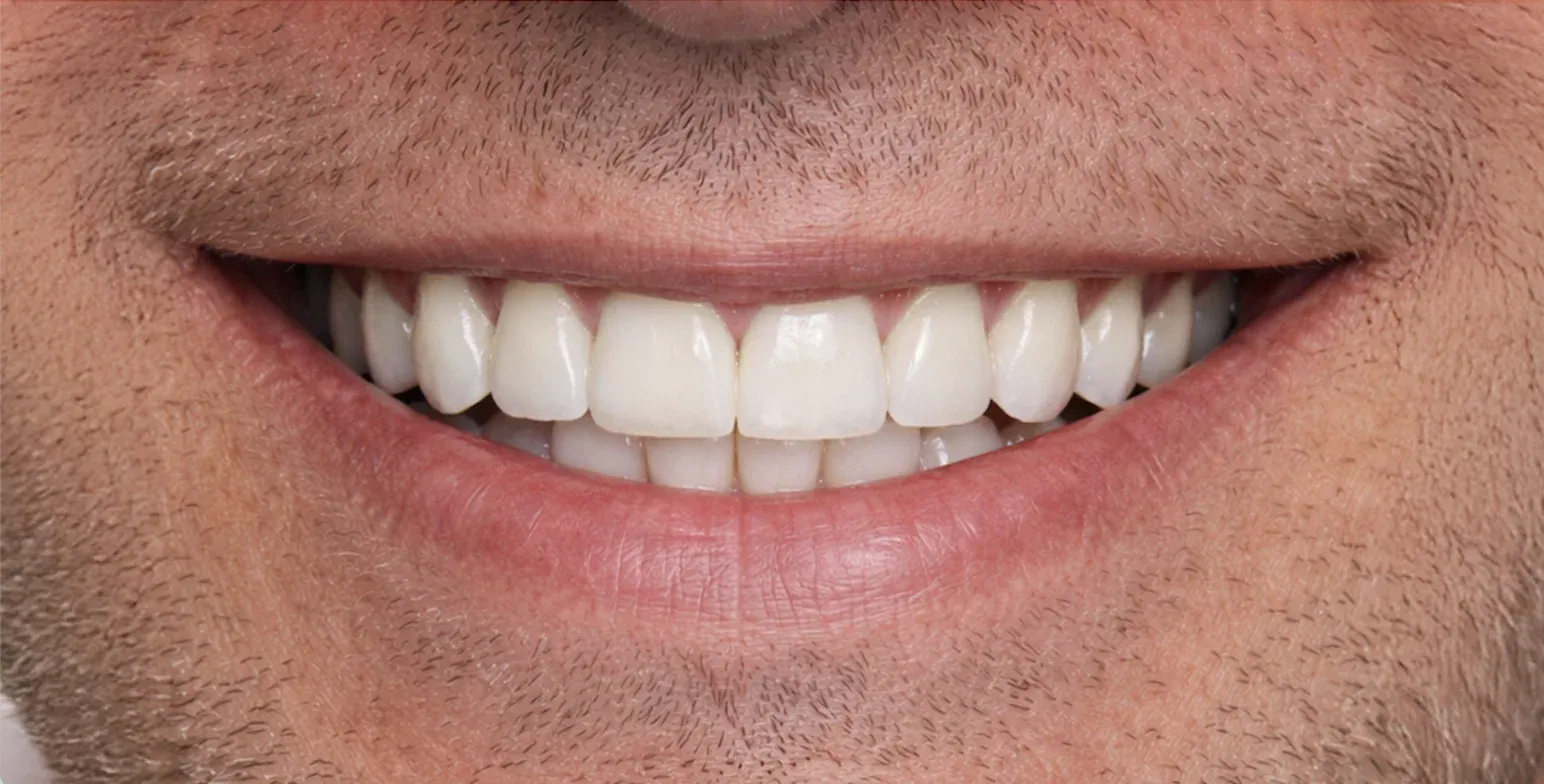 Dental Implant before-after12