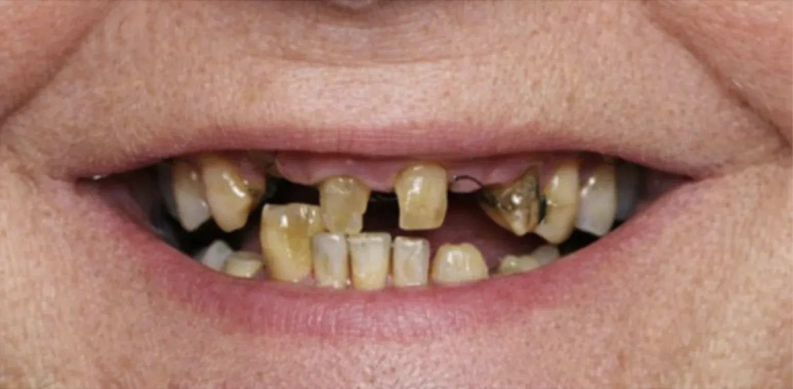 Dental Implant before-after3