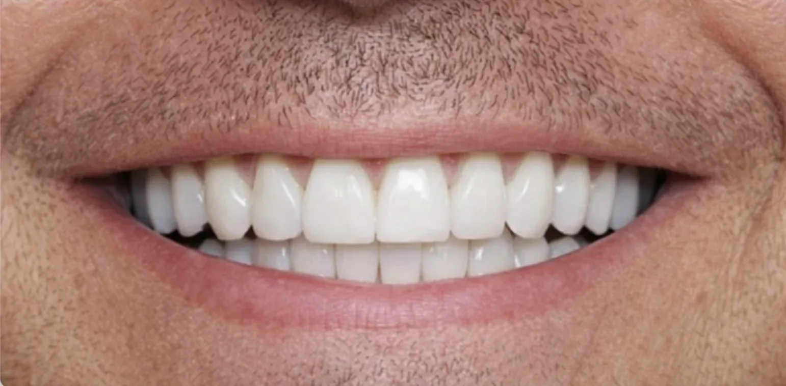 Dental Implant before-after4
