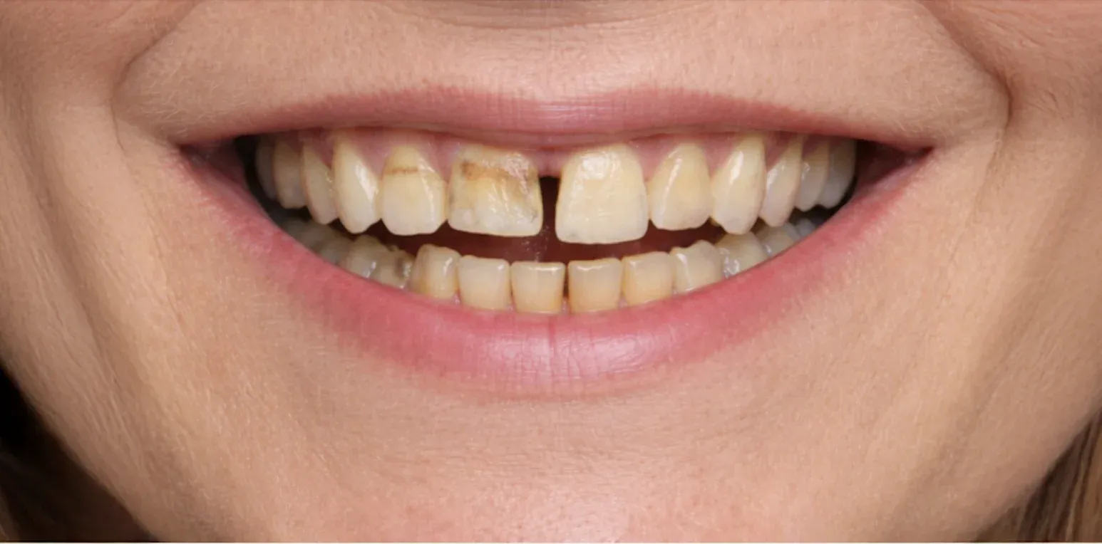 Dental Implant before-after5