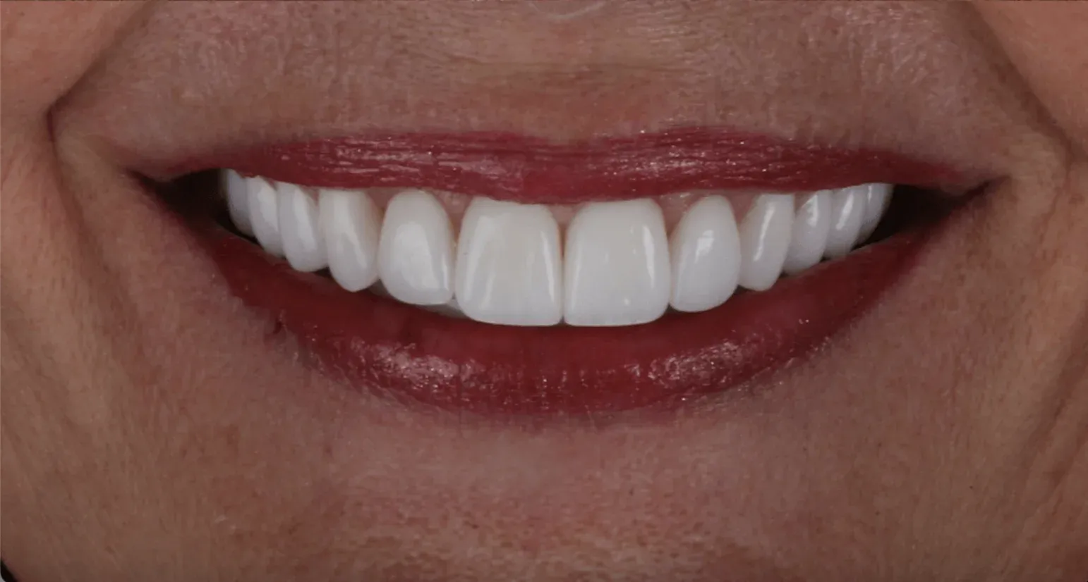 Dental Veneers before-after10