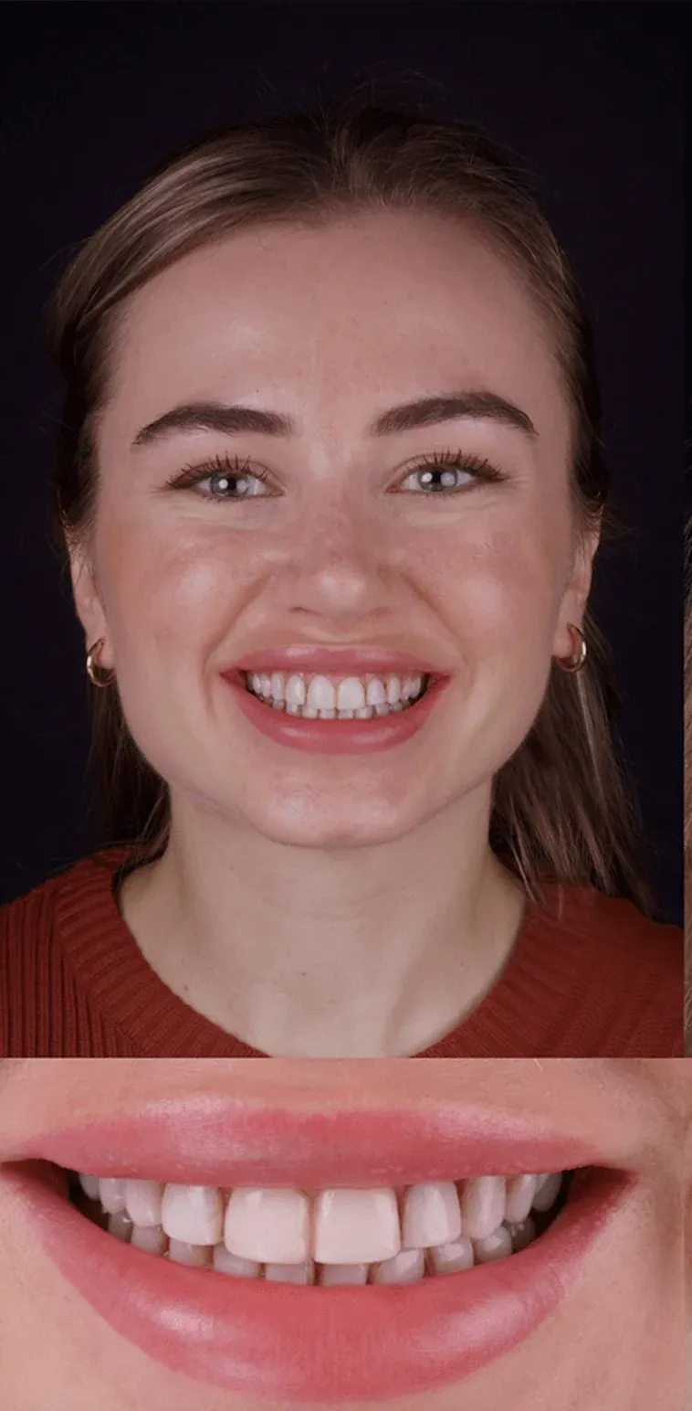 Dental Veneers before-after11