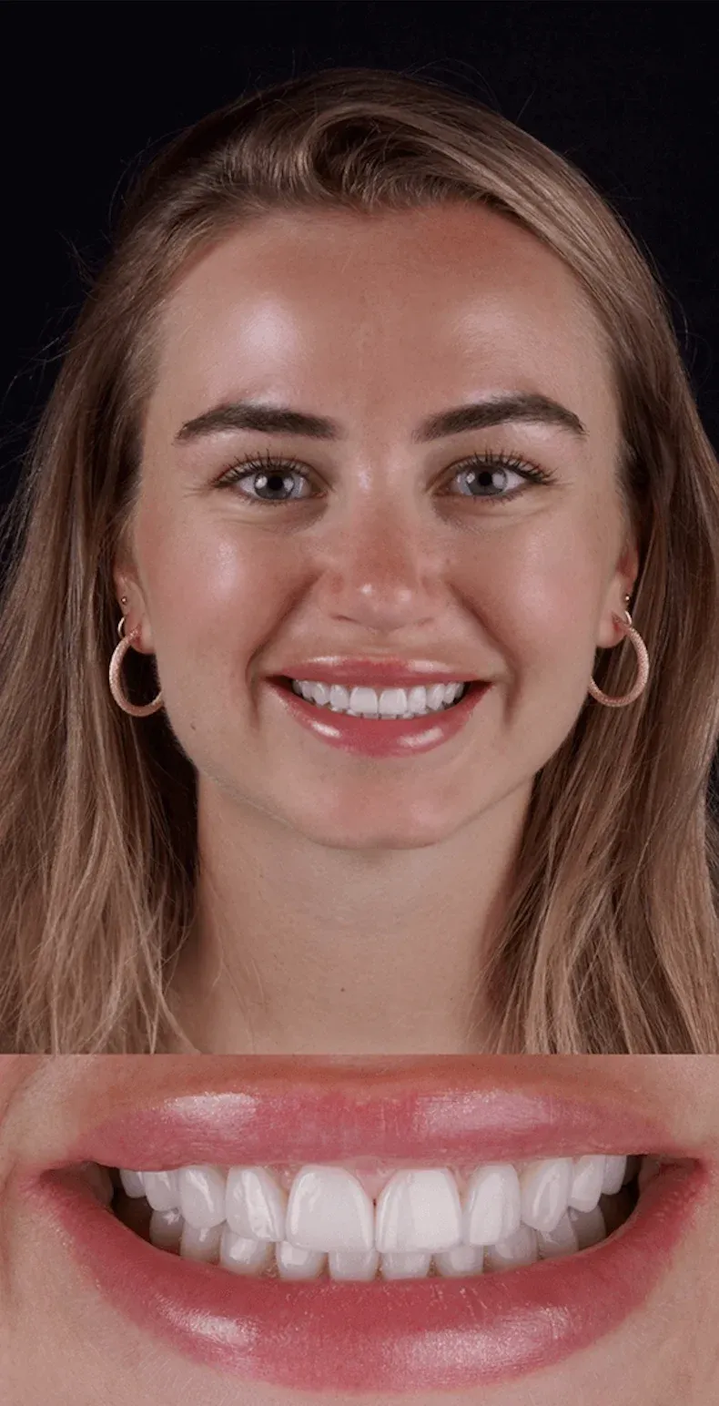 Dental Veneers before-after12